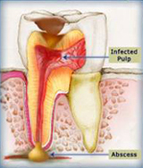 a decayed tooth