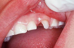 photo of tooth trauma